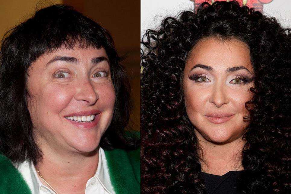 Лолита до&nbsp;и&nbsp;после пластики