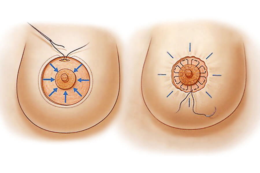 Коррекция ареол – не самая сложная операция, но проводить ее должен по-настоящему квалифицированный хирург