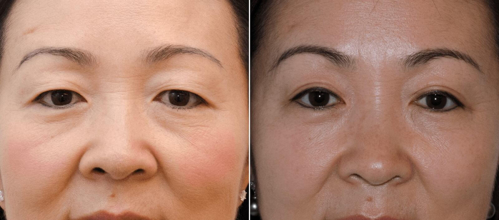 Блефаропластика позволяет убрать важную проблему азиатской внешности – нависшие верхние веки, которые с годами становятся все тяжелее и визуально прибавляют возраст