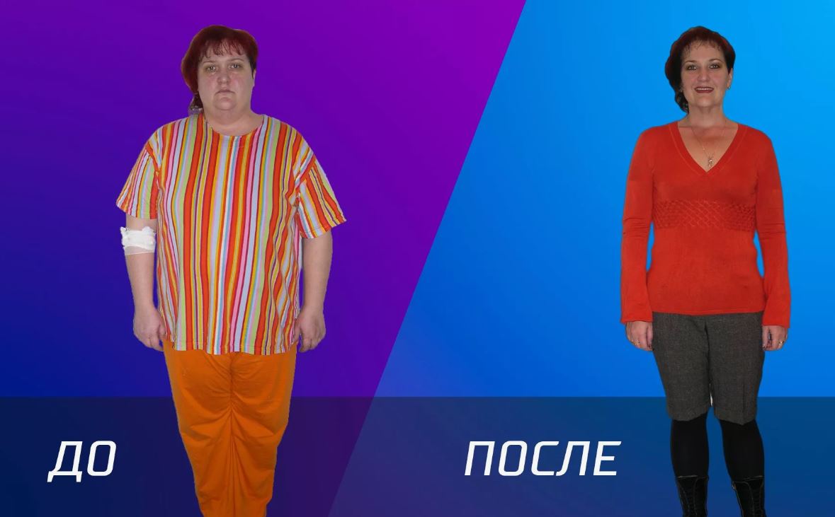 Бандажирование желудка &ndash; до&nbsp;и&nbsp;после