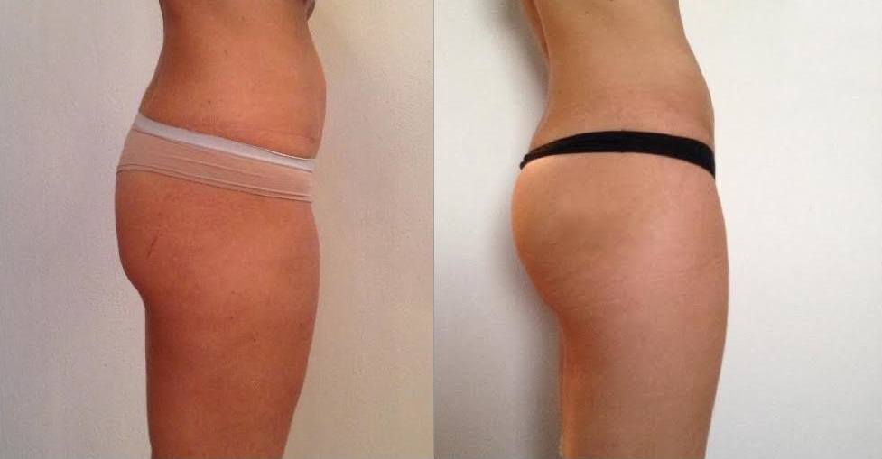 Если не жадничать при проведении бразильской подтяжки и не просить «чем больше, тем лучше», то можно получить естественный привлекательный результат