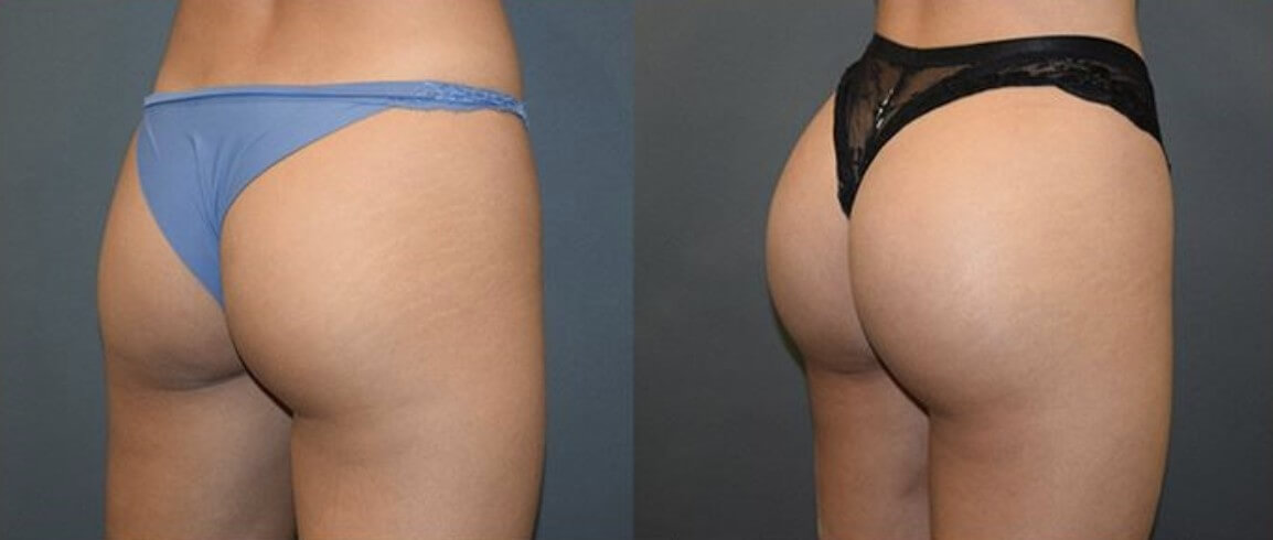 Бразильская подтяжка ягодиц – до и после
