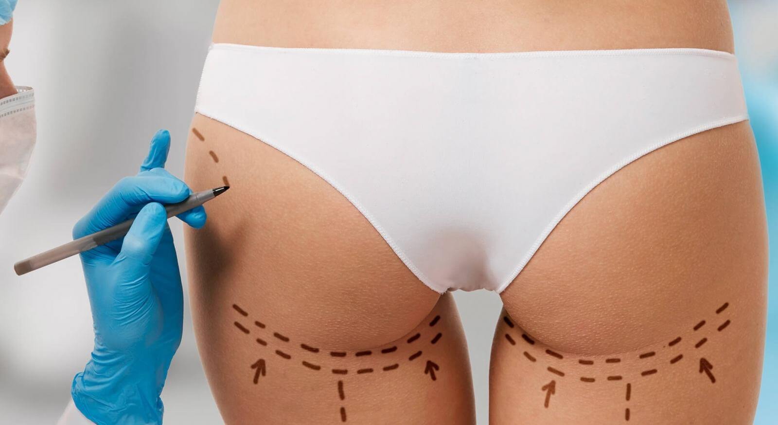 Бразильская подтяжка позволяет «слепить» попу мечты, но для ее сохранения на долгие годы придется вспомнить о диетах и спорте