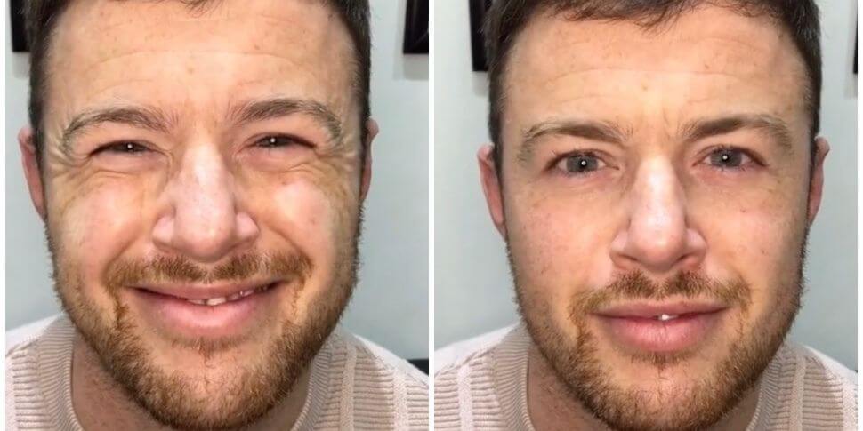 Мужчина до и после бротокса