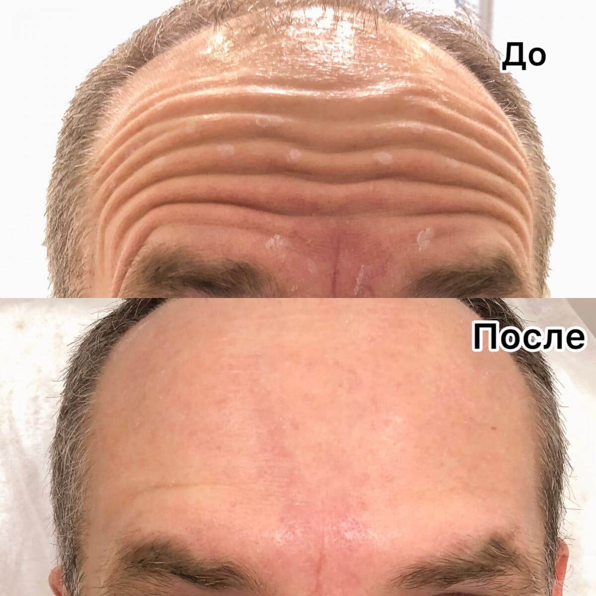 Мужчины часто прибегают к ботоксу для борьбы с морщинами на лбу