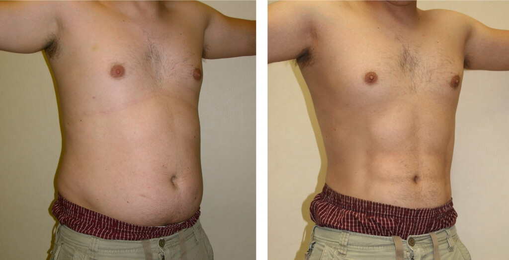 Липосакция живота и&nbsp;боков входит в&nbsp;&laquo;преображение папочки&raquo; практически в&nbsp;100% случаев