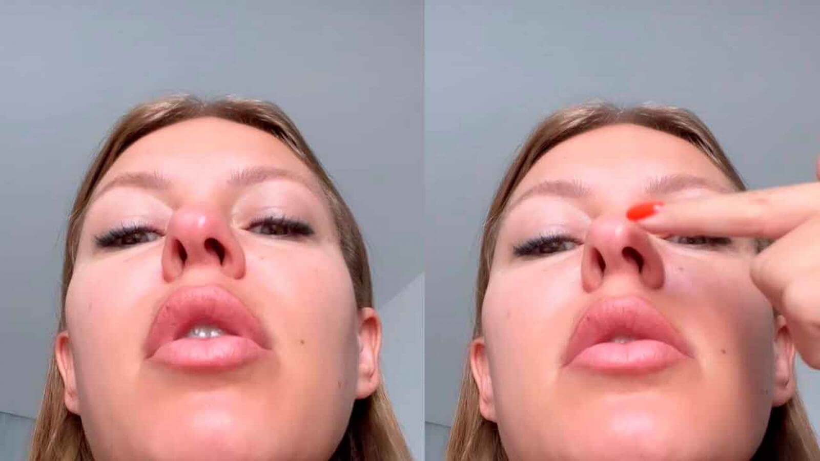 У Риты Дакоты был сильно искривлен нос, поэтому ринопластика стала ее спасением