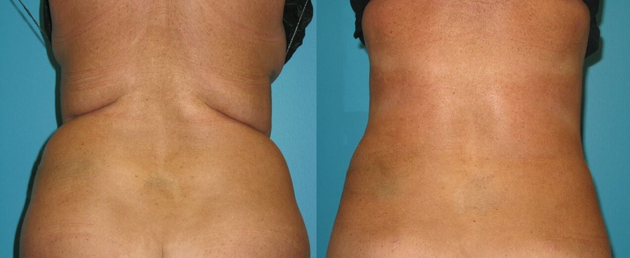 Разве такие роскошные результаты липосакции можно потерять из-за сиюминутного желания съесть булочку?