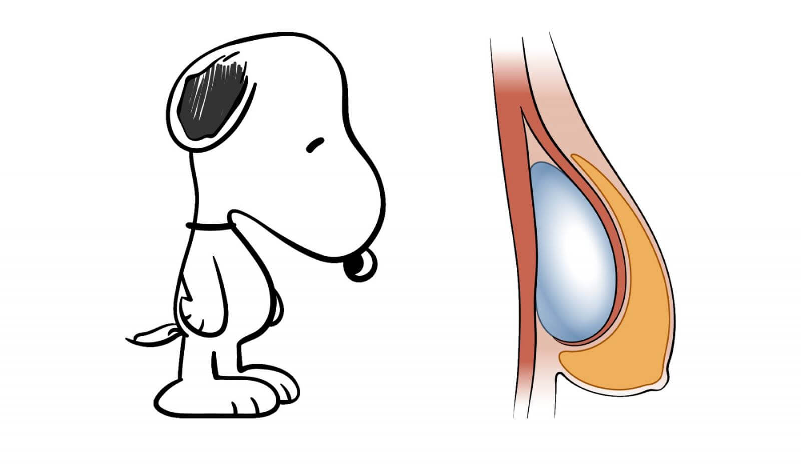 Эффект водопада на&nbsp;груди сравнивают с&nbsp;грустной собачкой Снупи