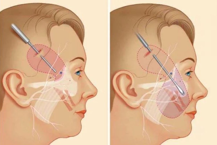 Эндоскопические методы позволяют расположить хирургические доступы в&nbsp;незаметных местах 