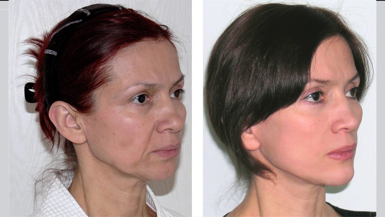 Результаты эндоскопической подтяжки при начальных и&nbsp;средних стадиях старения очень выразительные 