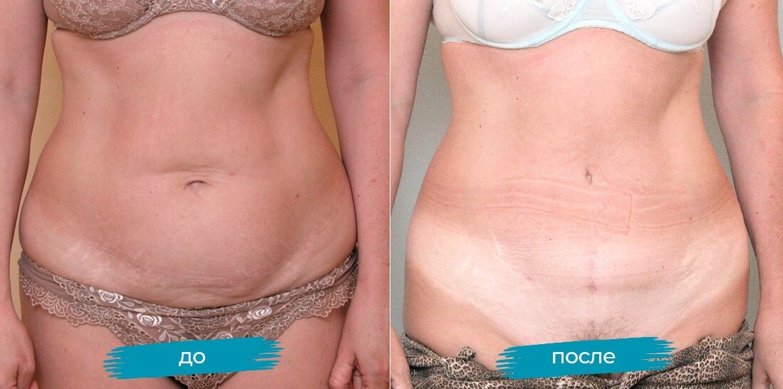Результаты эндоскопической абдоминопластики &ndash; плоский живот и&nbsp;практически никакого шрама
