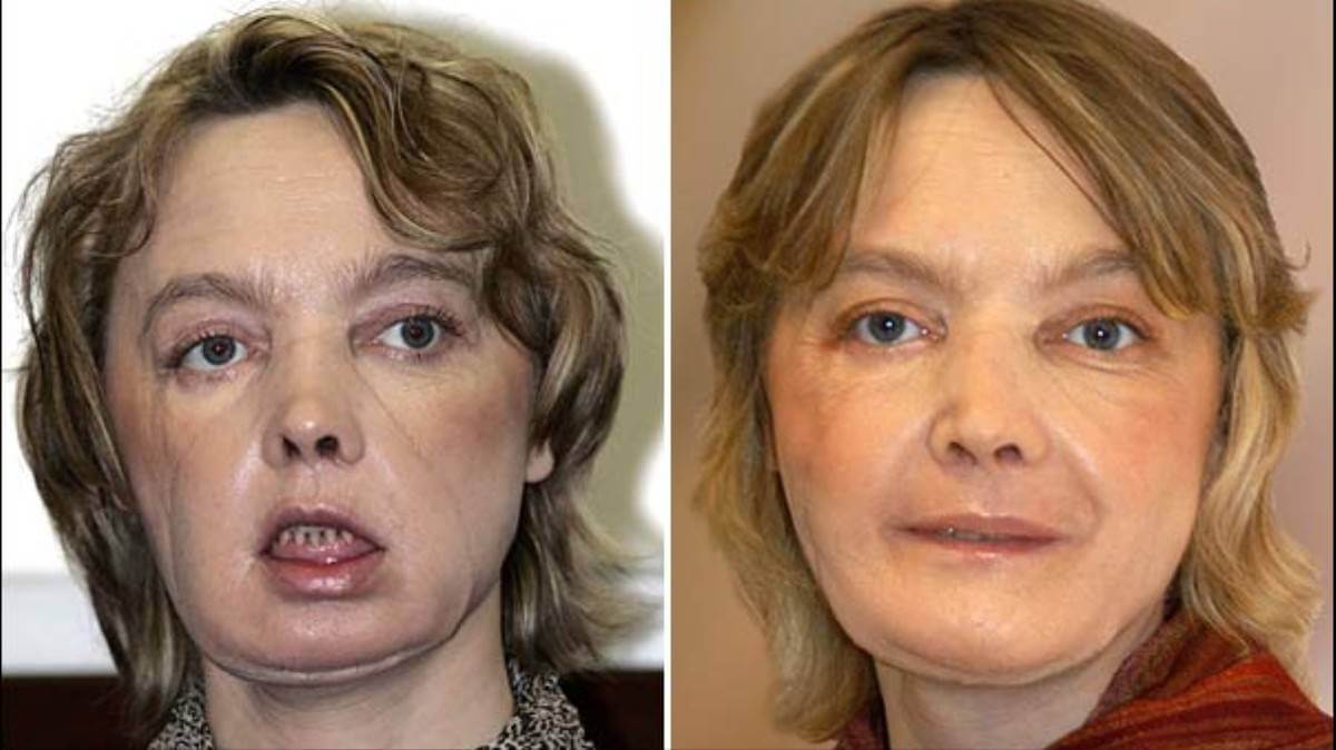 Пересадка кожи на&nbsp;лице позволяет скорректировать самые серьезные повреждения после глубоких ран и&nbsp;ожогов