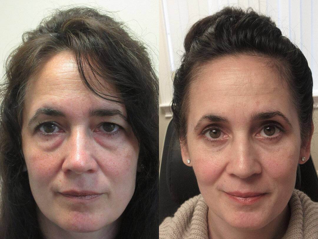 Блефаропластика мгновенно переносит вас на 10-15 лет назад