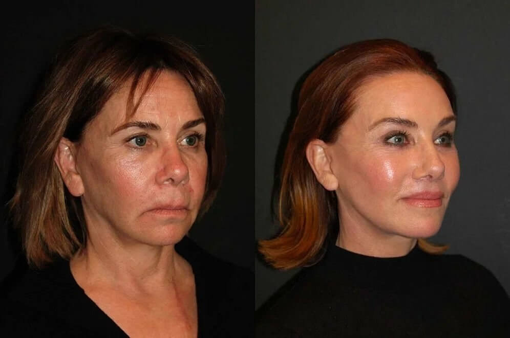 После пластики легко поверить, что в 40 лет жизнь только начинается