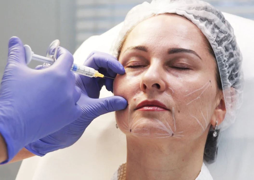 Правильная схема введения филлеров помогает сохранить молодость и&nbsp;красоту на&nbsp;долгие годы