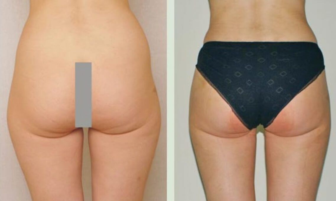 А-образная попа до&nbsp;и&nbsp;после липосакции