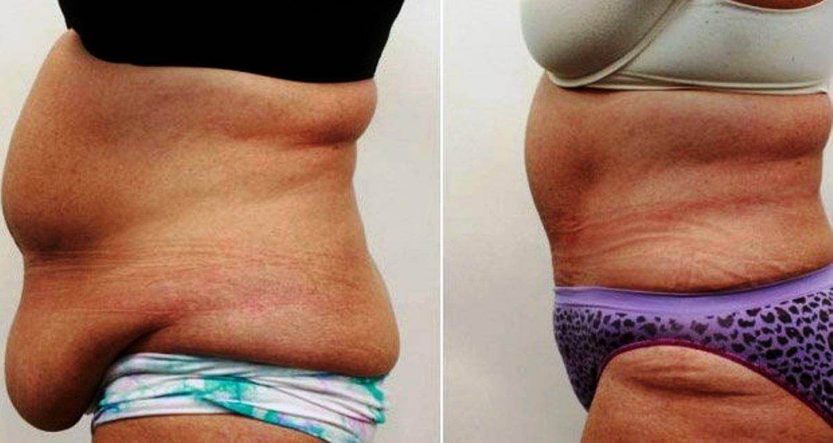 Лишний жир на лобке не стоит путать с жировым фартуком на животе, хотя часто эти проблемы идут рука об руку, да и устраняются одними и теми же методами