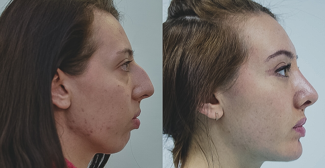 Результаты оморфиопластики по-настоящему восхищают и&nbsp;вдохновляют