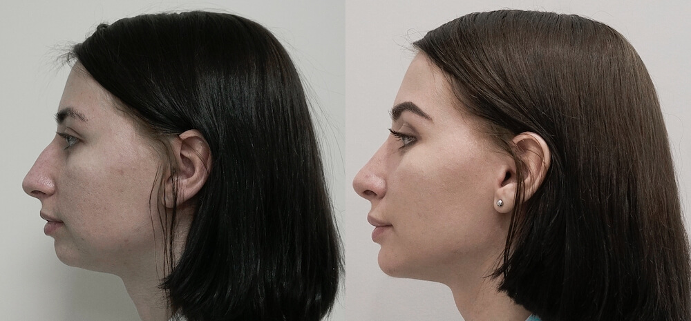 Гармонизация лица &ndash; фото до&nbsp;и&nbsp;после