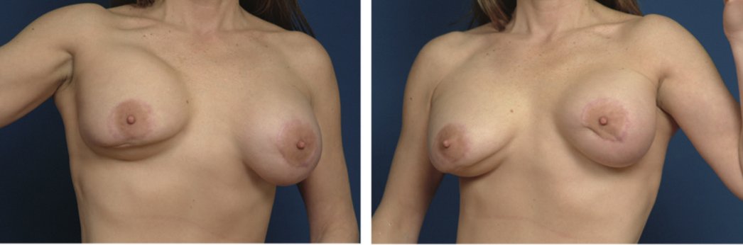 Так выглядит серьезная степень гиперанимации груди