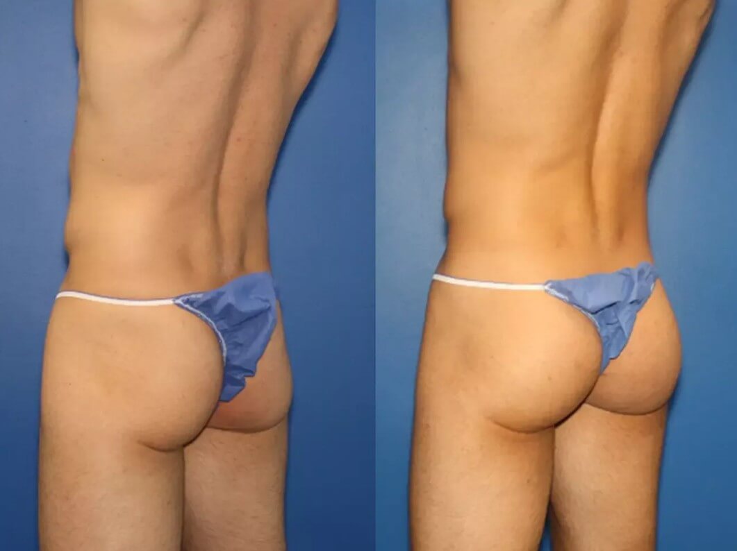 Мужчины делают глютеопластику наравне с&nbsp;женщинами