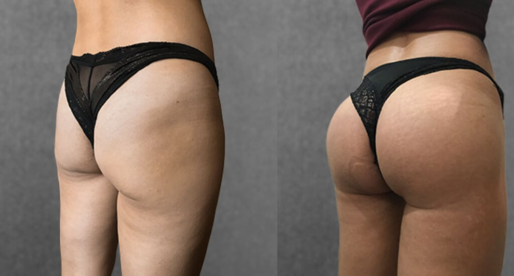 Качественная глютеопластика обеспечивает красоту ягодиц на&nbsp;много лет