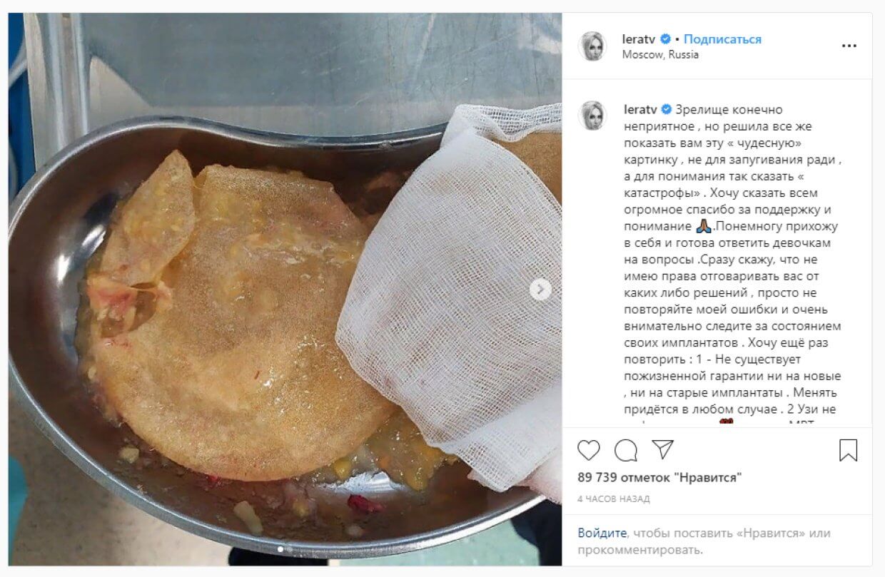 Лера Кудрявцева столкнулась с разрушением импланта и показала свои подписчикам, как он выглядит сразу после извлечения из груди