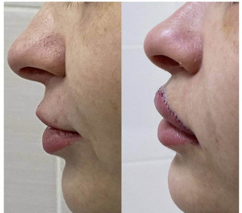 К концу первого этапа реабилитации после хейлопластики снимают внешние швы, но&nbsp;отек еще держится