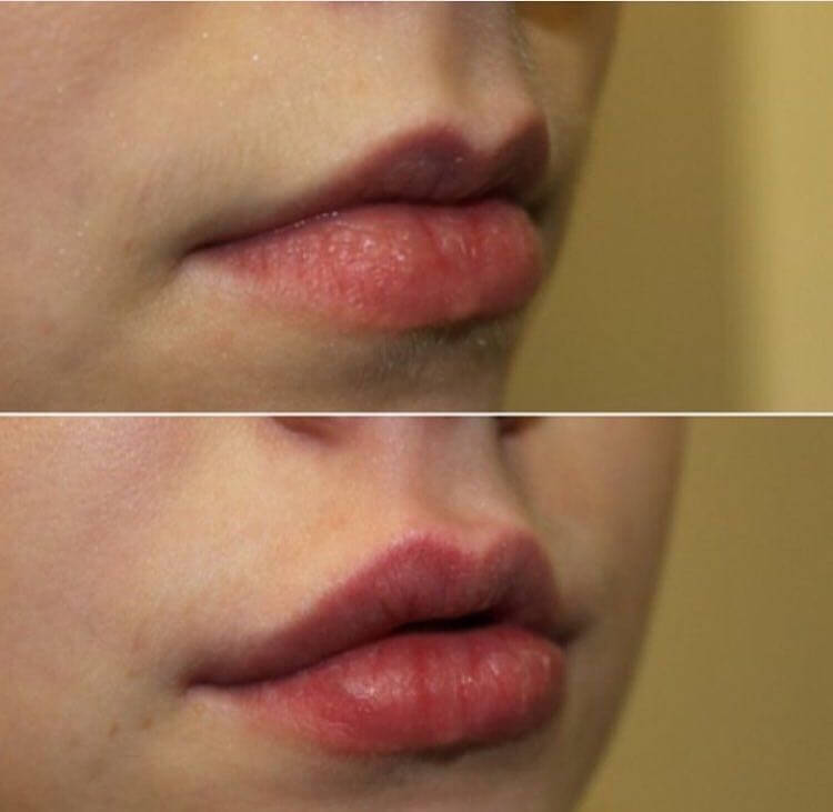 Хейлопластика до&nbsp;и&nbsp;после &ndash; результат налицо