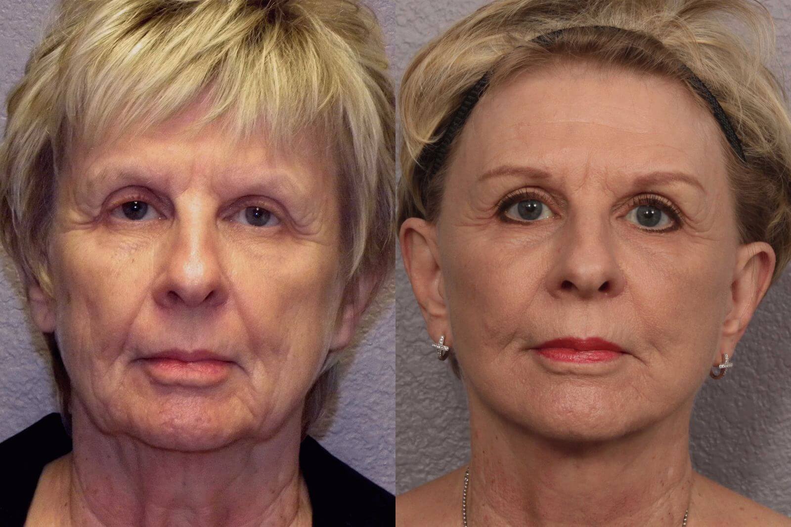 В возрасте 60+ лет серьезно улучшить внешность можно только кардинальными методами – с помощью пластической хирургии
