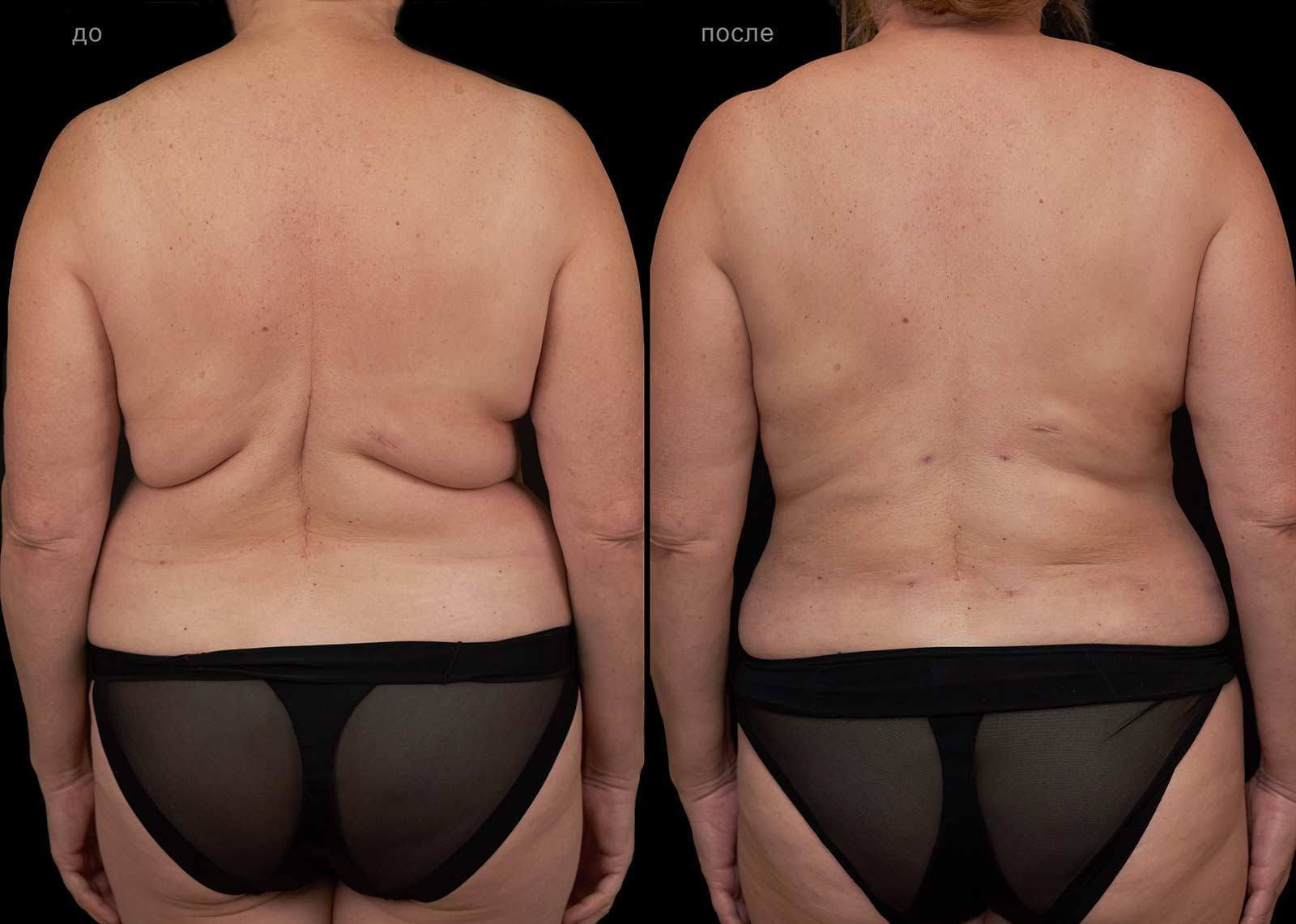 Если обычные методы похудения не помогают, липосакция станет вашим спасением