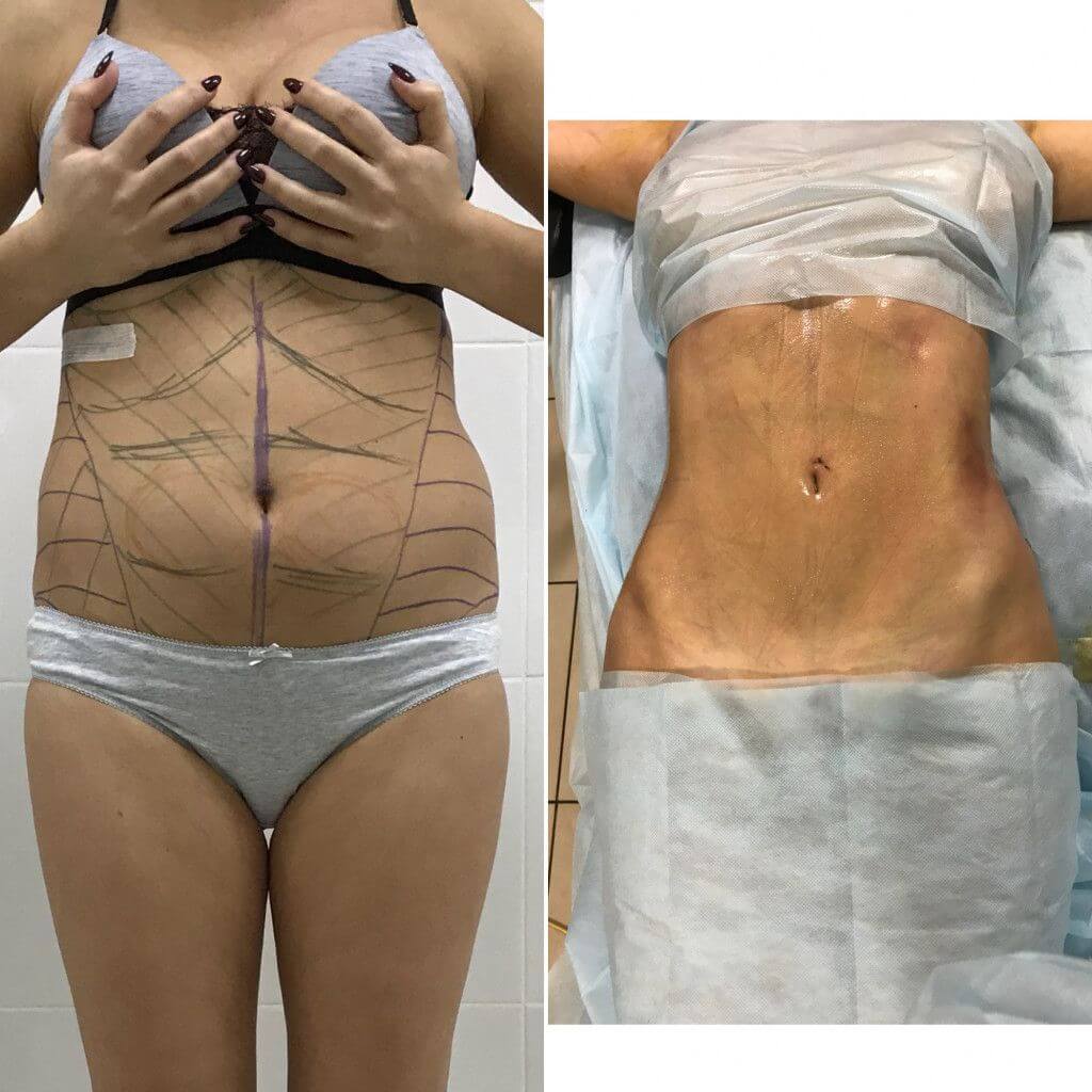 Чаще всего имиджевая пластика включает целый комплекс процедур. Они могут проводиться одновременно или поэтапно