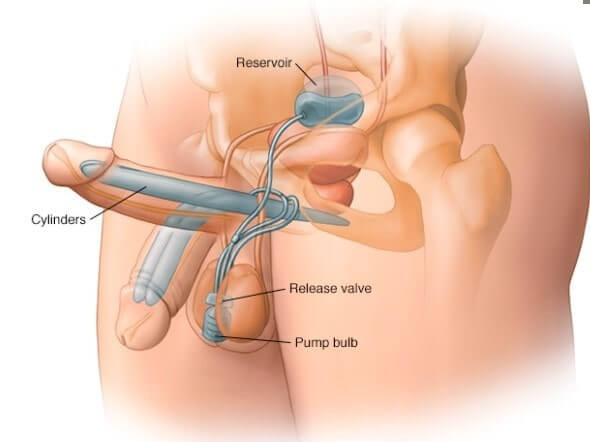 Так выглядит в&nbsp;действии система с&nbsp;надувными имплантами пениса