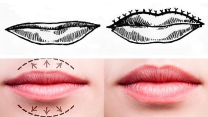 Схема выполнения пластики губ по методу Кессельринга