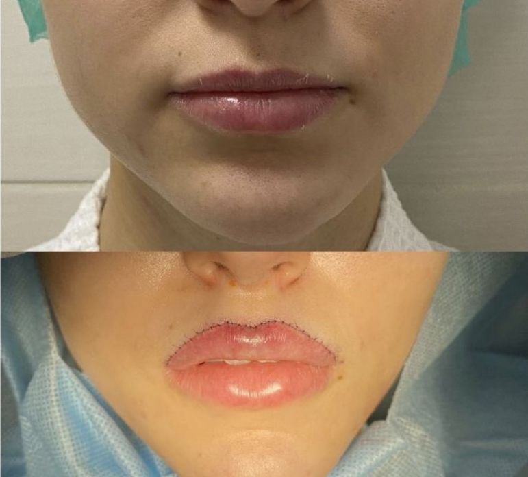 Пластика губ по Кессельрингу – фото до и после