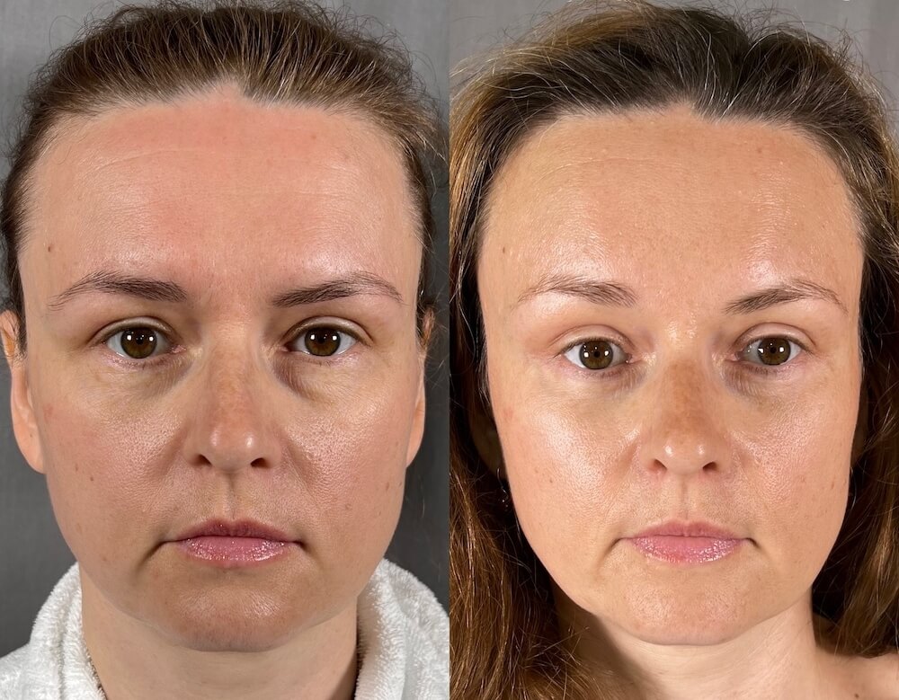 Эндоскопическая подтяжка разглаживает лоб и&nbsp;приподнимает брови