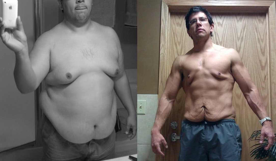 Лишняя кожа – проблема всех, кто похудел с большого веса