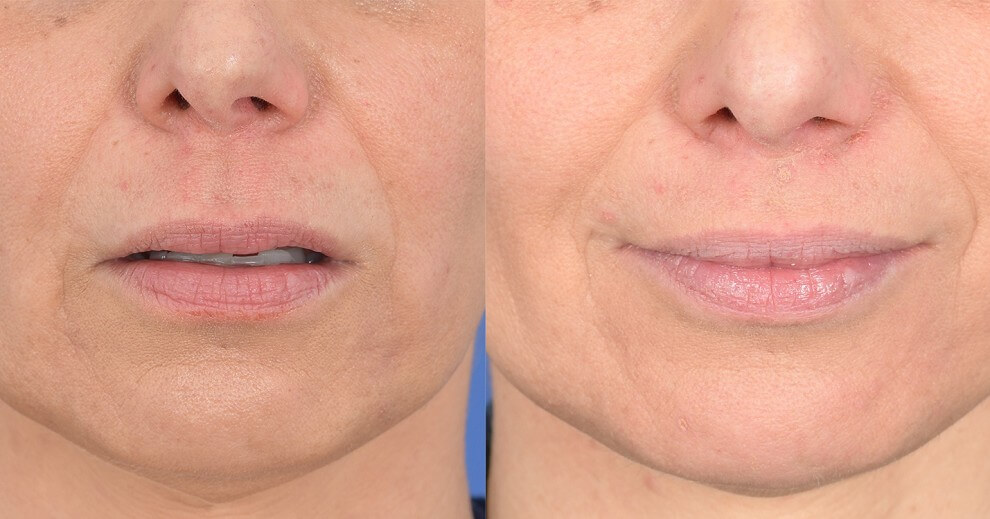 Пластика уголков губ &ndash; до&nbsp;и&nbsp;после