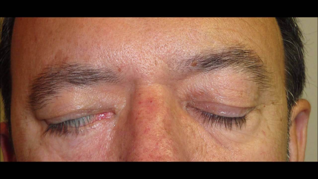 Лагофтальм после пластики век &ndash; некрасиво, некомфортно и&nbsp;чревато проблемами со&nbsp;здоровьем