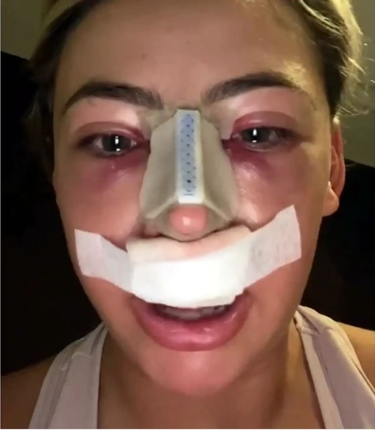 Лицо Леони Смит после операции выглядит не лучшим образом. Но скоро восстановление закончится и все будет куда лучше