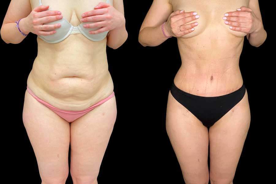Абдоминопластика не всегда требует проведения липосакции – если жировые отложения незначительные, то операция сразу дает отличный результат