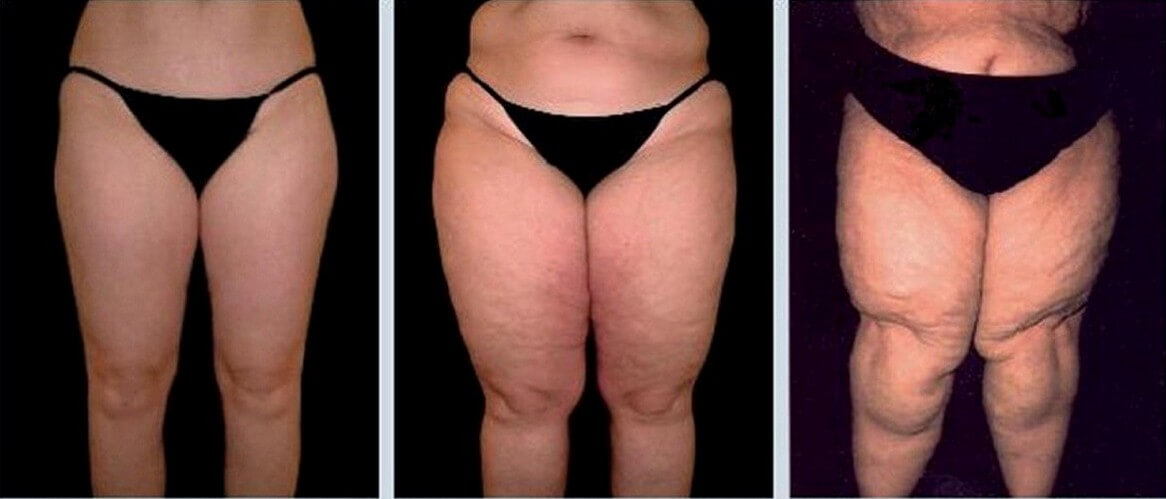 Липедема в&nbsp;жизни