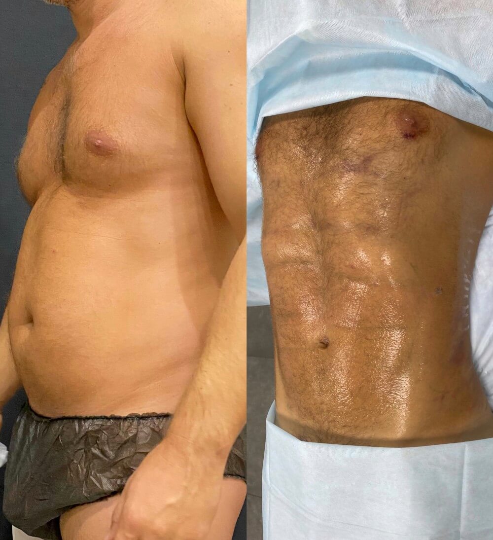 Мужская комплексная липосакция дает отличные результаты