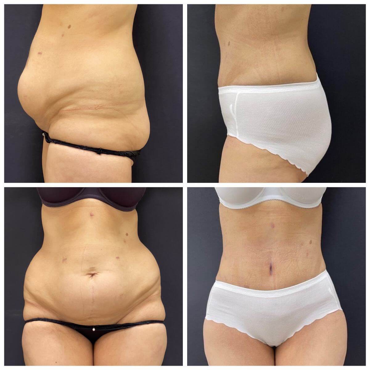 Если после абдоминопластики остаются небольшие жировые отложения (особенно часто они остаются в нижней части живота), может потребоваться липосакция