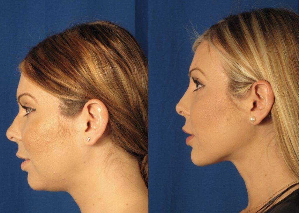 Липосакция подбородка &ndash; до&nbsp;и&nbsp;после 