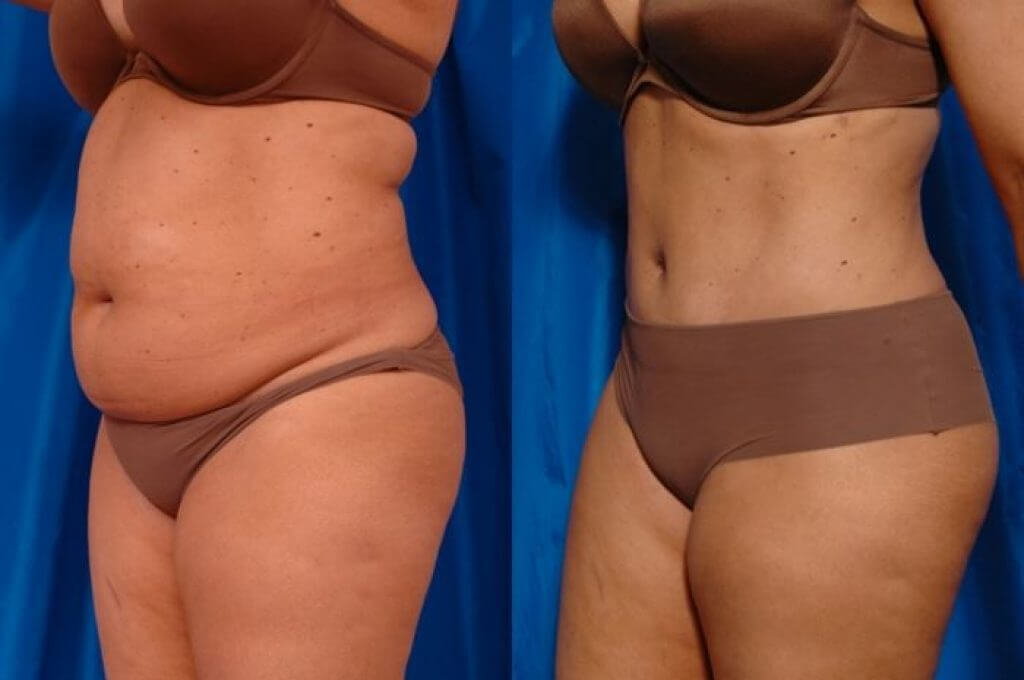 Липосакция живота &ndash; до&nbsp;и&nbsp;после 