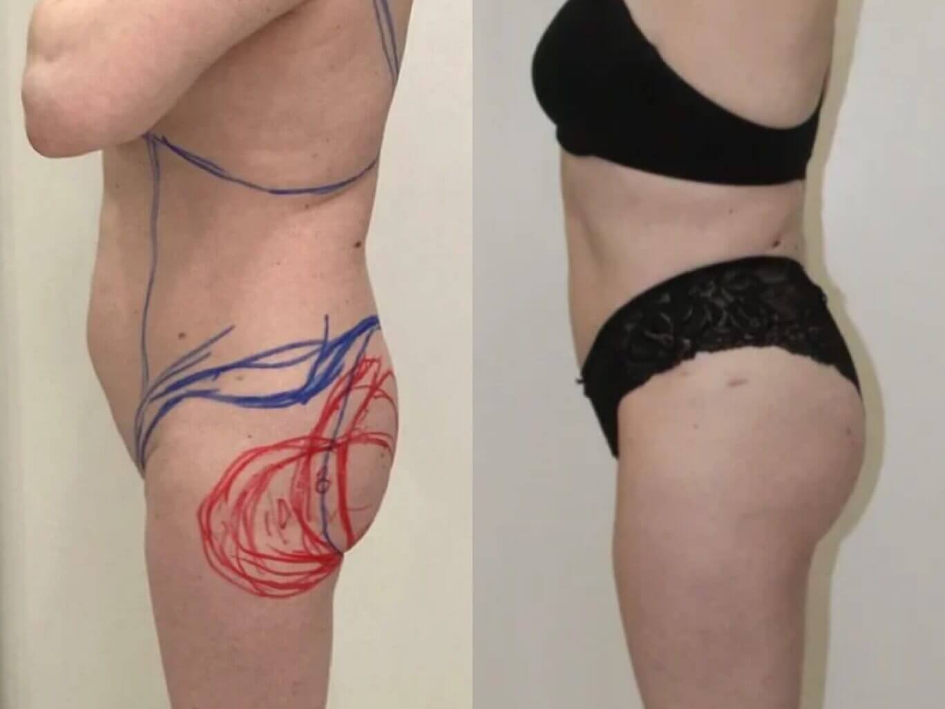 Липофилинг – отличный способ похудеть в области живота и боков и набрать заветные объемы в ягодицах