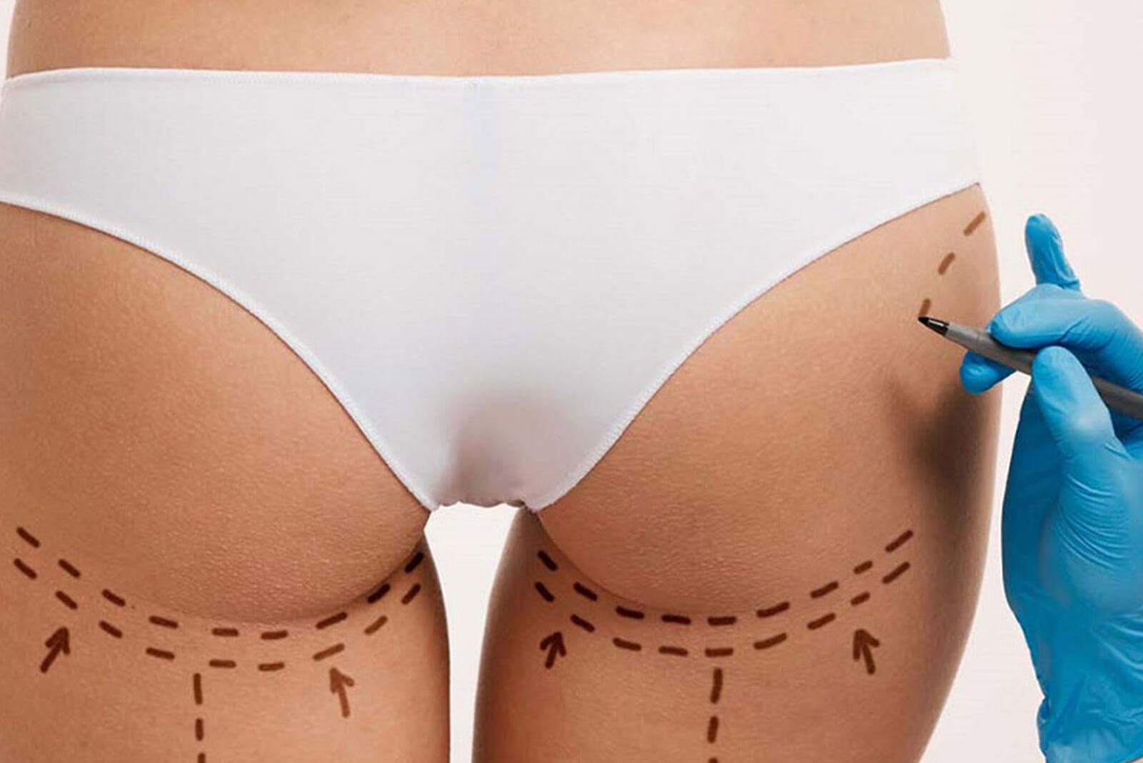 Проколы при липофилинге минимальные и становятся незаметными уже спустя несколько дней