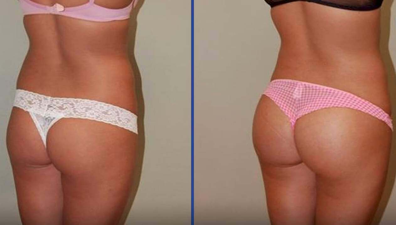 Липофилинг позволяет обрести круглую подтянутую попу без изнурительных тренировок с негарантированным результатом